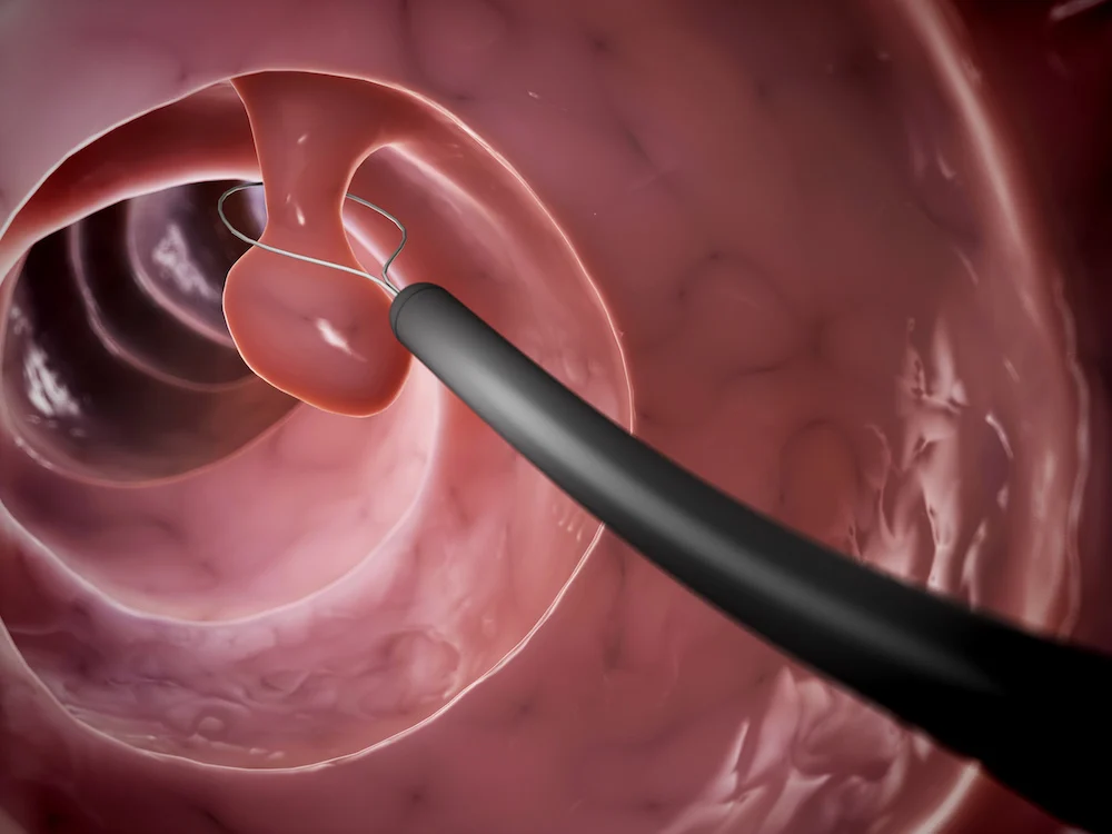 Blood Colon Cancer Screening: Exploring Modern Approaches