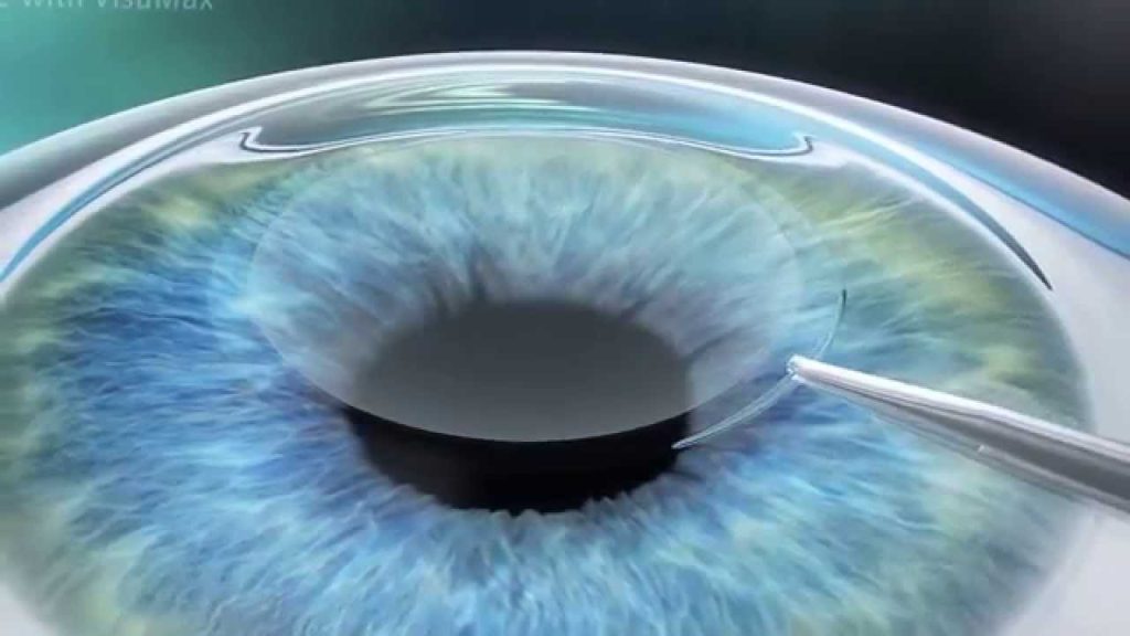 Small Incision Lenticule Extraction (SMILE) – A Minimally Invasive Laser Eye Procedure