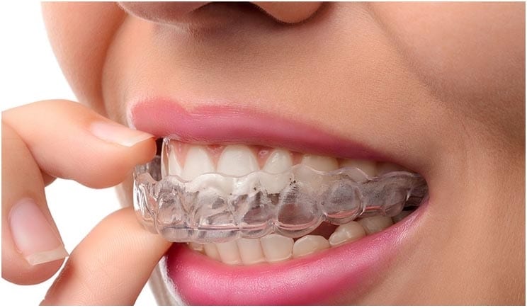 Transform Your Smile with Orthodontic Clear Aligners: A Modern Alternative to Braces